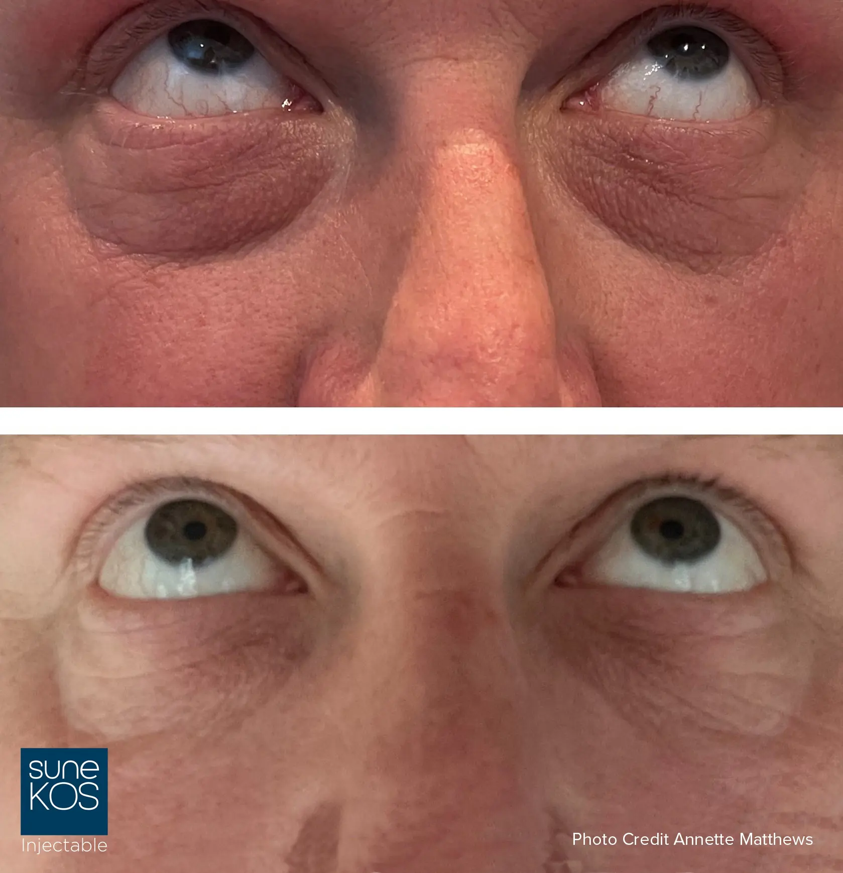 Dark circles under eyes treatment London